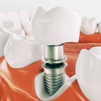 Model showing each part of a dental implant