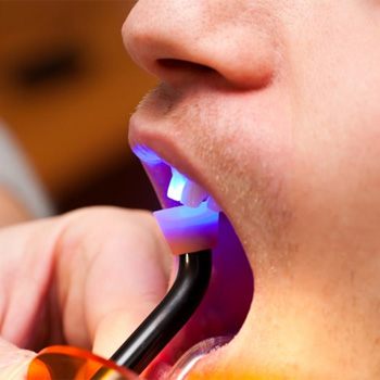 dentist hardening resin on a patient’s tooth   