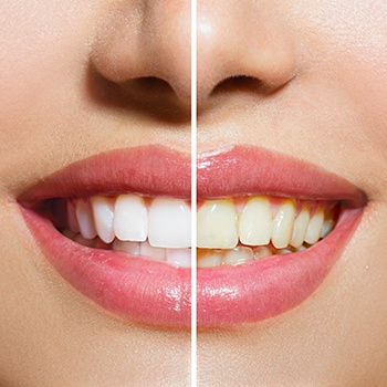 Smile before and after teeth whitening