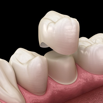3D image of a crown being put on a tooth