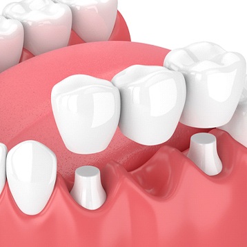 Digital image of a dental bridge