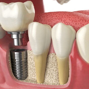 Image of a dental implant in the lower jaw