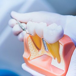 A dentist cleaning an model containing a dental implant