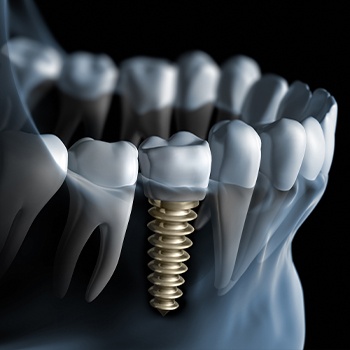 A diagram of an integrated dental implant