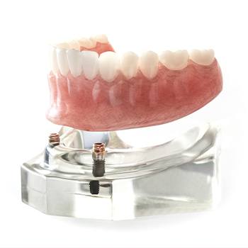 An implant denture floating over a model containing dental implants