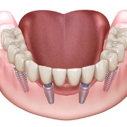 3D illustration of an implant denture