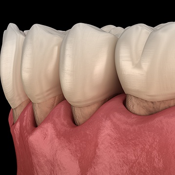 a patient showing off their teeth and gums