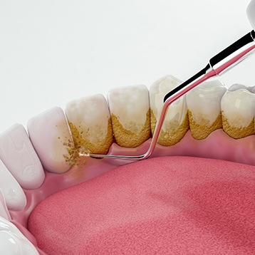 a patient examining their gums