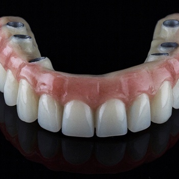 Implant denture with attachments for six dental implants