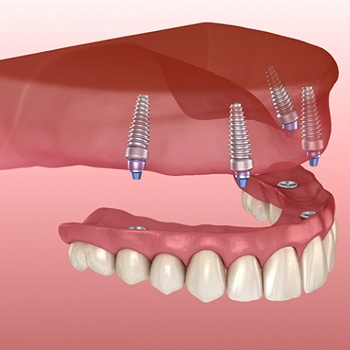 Implant denture being placed on four dental implants