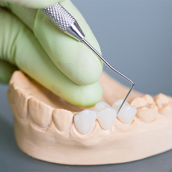 Model smile with fixed bridge dental restoration