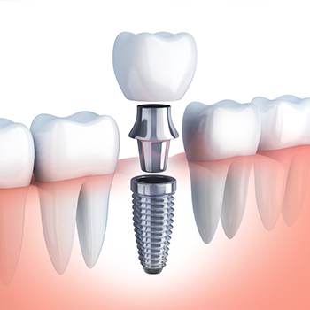 Animation of implant supported dental crown placement