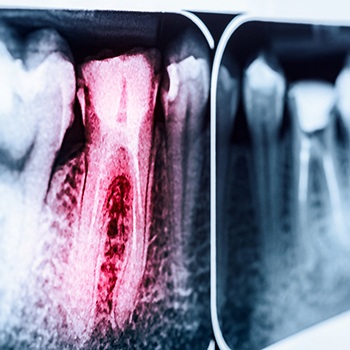a dental X-ray with a tooth highlighted in red