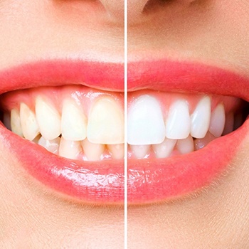 Teeth whitening in Wylie before and after