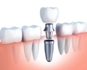 dental implant diagram