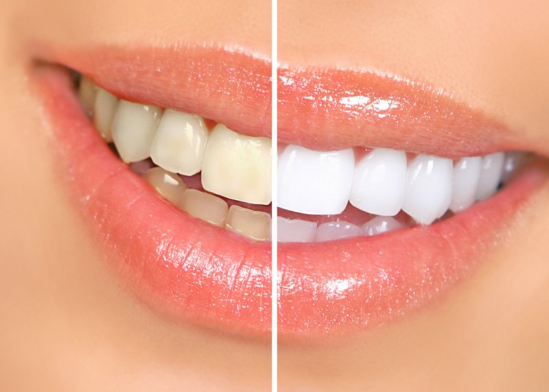 an up-close view of a person’s smile before and after teeth whitening